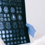 Una Nuova Prospettiva sull'Alzheimer: Ricerche Recenti Rivoluzionano la Comprensione della Malattia